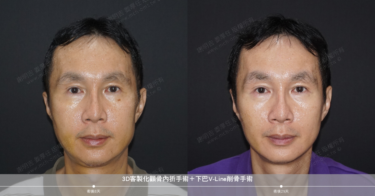 2019-10-26 3D Customized Zygomatic Inward Reduction Surgery + Chin V-Line Bone Reduction Surgery
