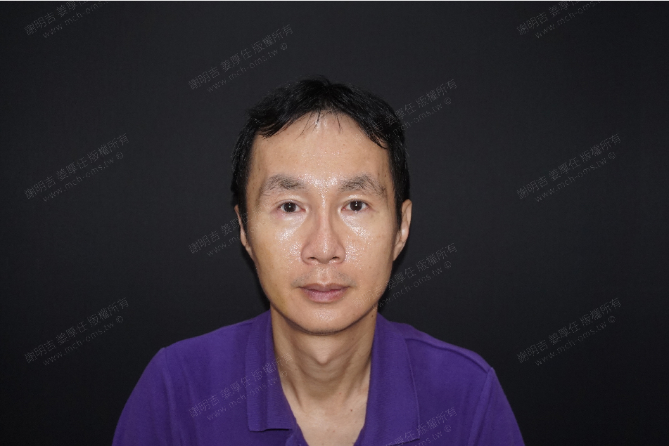 2019-10-26 3D Customized Zygomatic Inward Reduction Surgery + Chin V-Line Bone Reduction Surgery photo 1