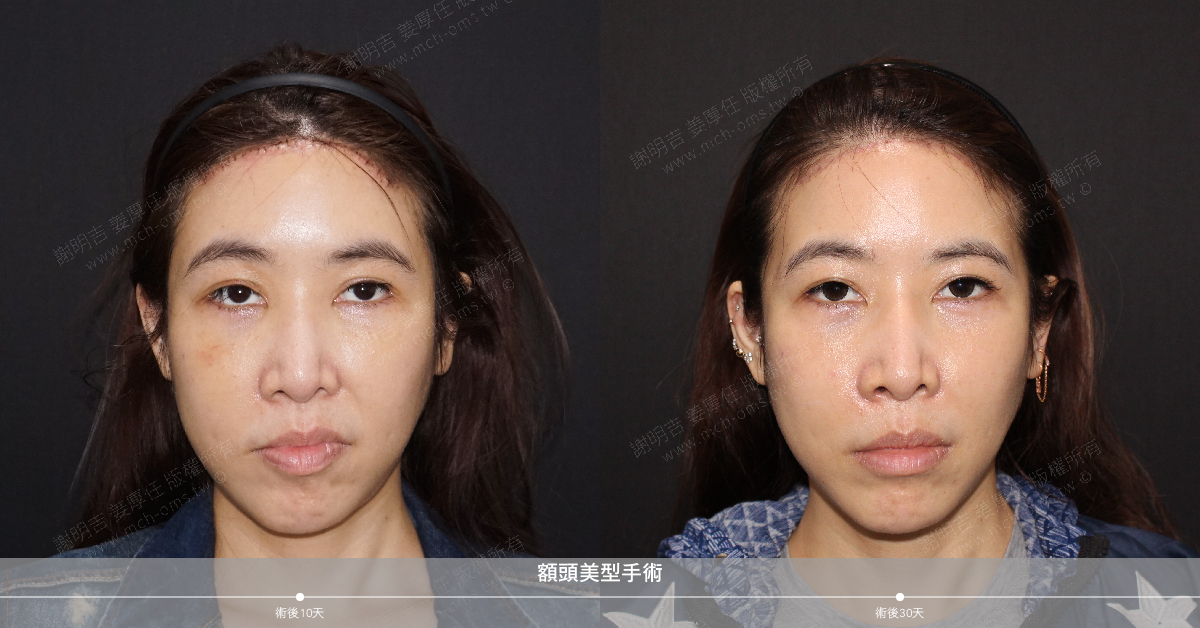 2019-12-14 額頭美型手術