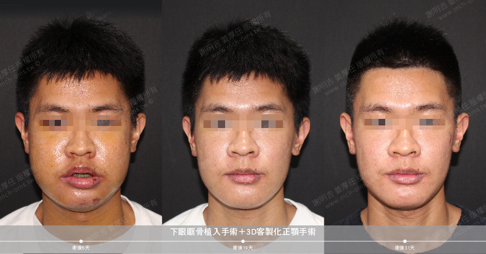 2020-03-07 Lower orbital bone implant surgery + 3D customized orthognathic surgery
