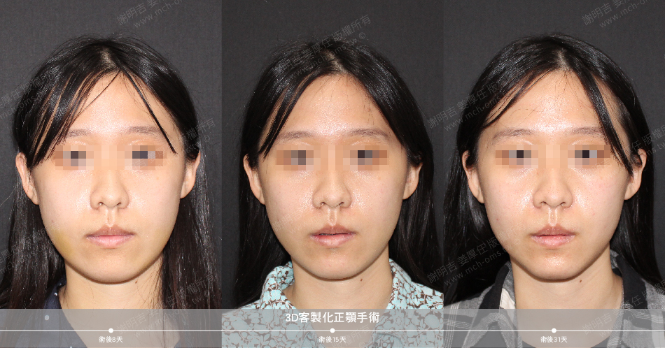 2020-06-08 3D customized orthognathic surgery