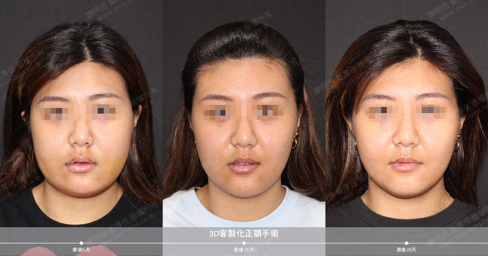 2020-07-01 3D customized orthognathic surgery