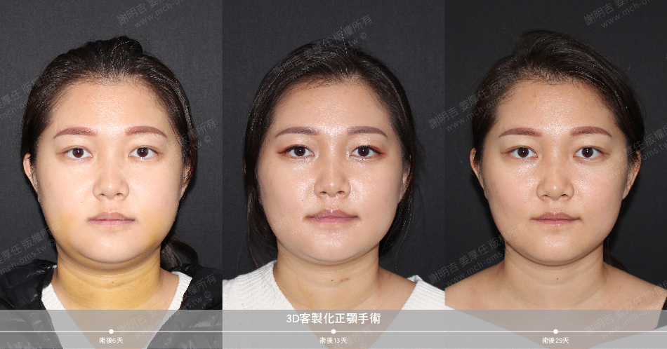 2021-01-12 3D customized orthognathic surgery