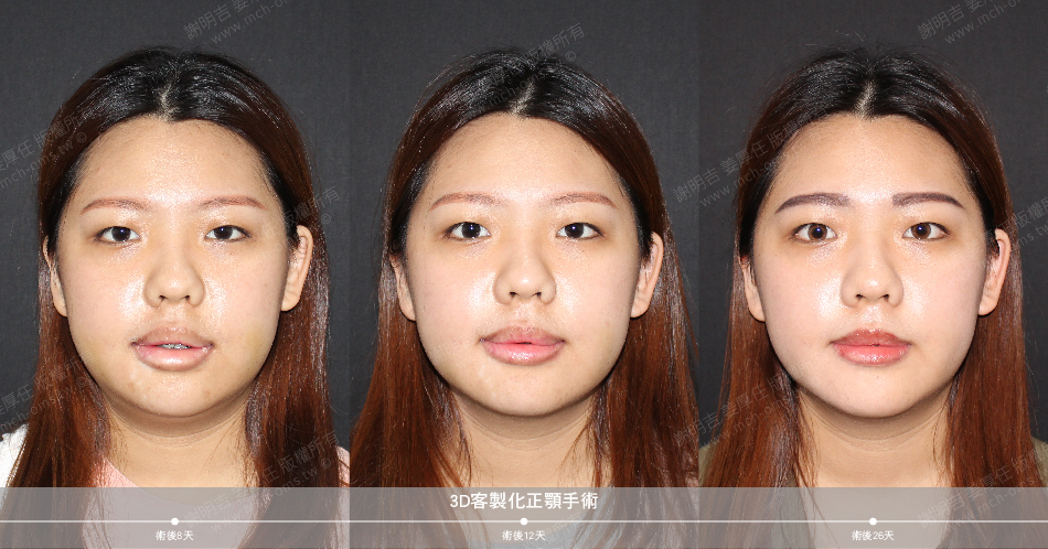 2021-02-24 3D customized orthognathic surgery