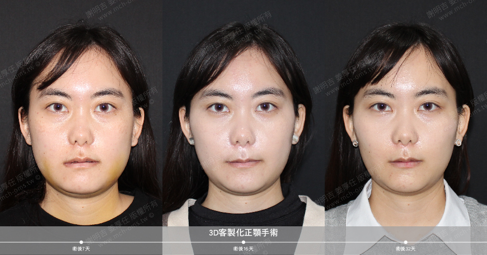 2021-03-05 3D客制化正颚手术(之一)
