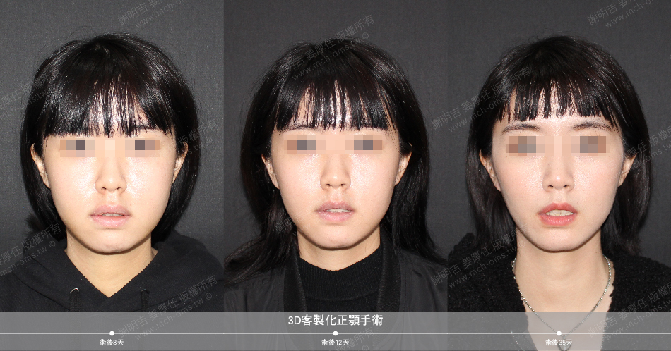 2021-03-06 3D客制化正颚手术(之一)