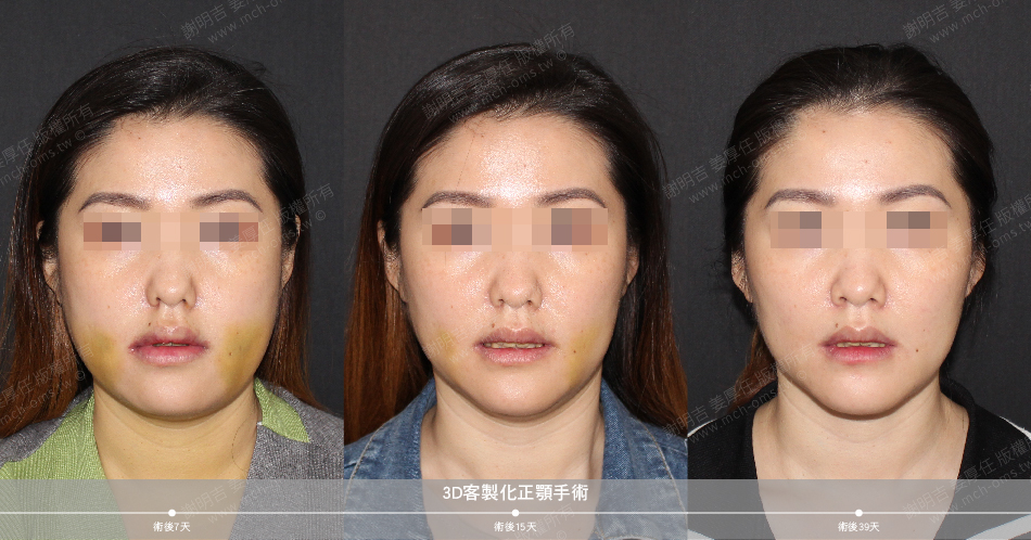 2021-06-01 3D customized orthognathic surgery