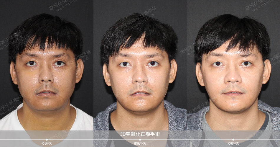 2021-01-04 3D customized orthognathic surgery (Part 2)
