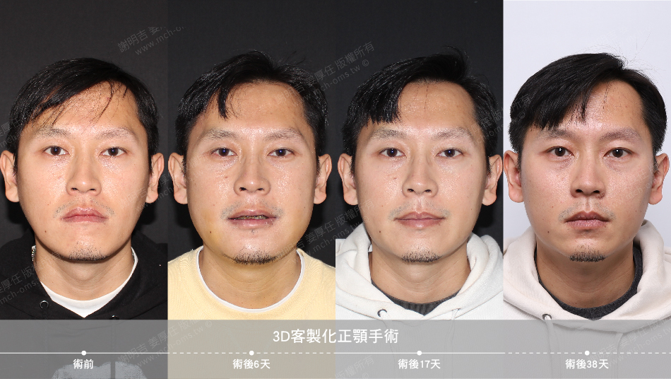 2022-01-08 3D客制化正颚手术