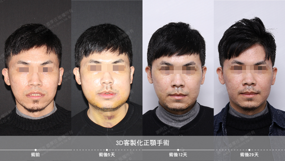 2022-01-22 3D客製化正顎手術