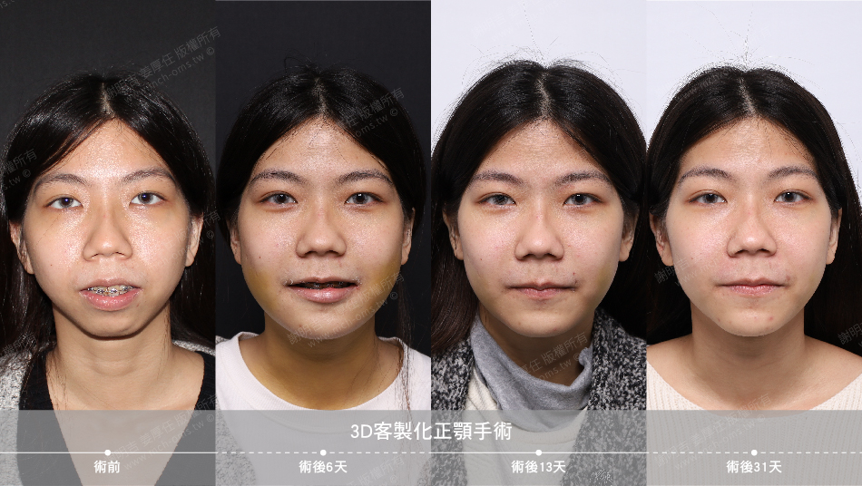 2022-01-29 3D客製化正顎手術