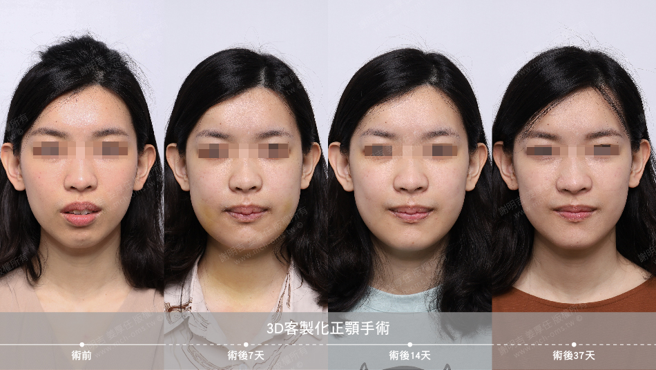 2022-05-07 3D客制化正颚手术(之二)