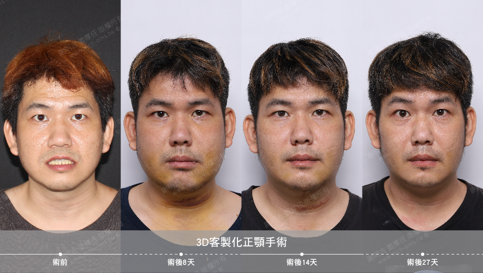 2022-04-25 3D客製化正顎手術