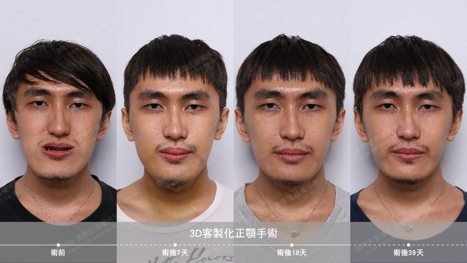 2022-07-30 3D客制化正颚手术(之一)