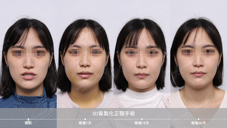 2022-11-26 3D客製化正顎手術