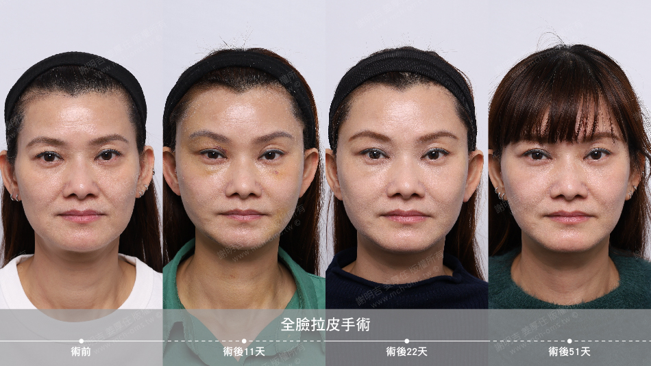 2023-01-28 全臉拉皮