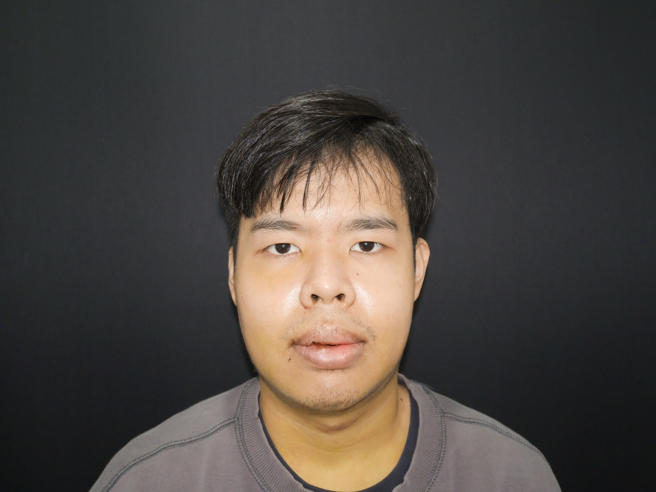 2018-04-14 3D客製化正顎手術（之一） 相關照片 5