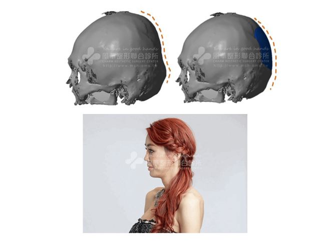 yahoo新聞 3D列印後腦杓? 話題女王整頭骨