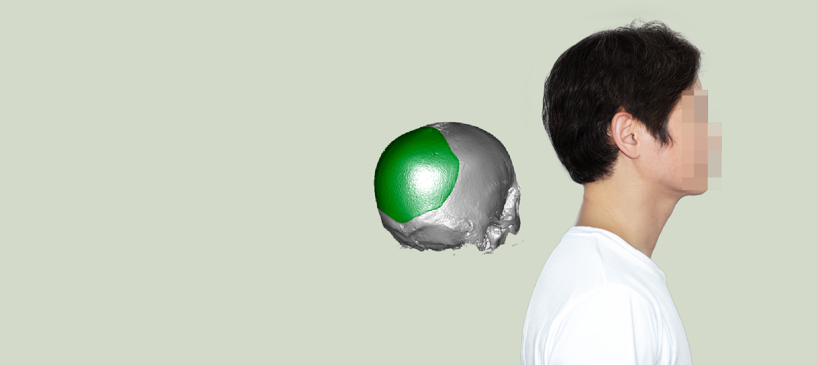 Occipital augmentation