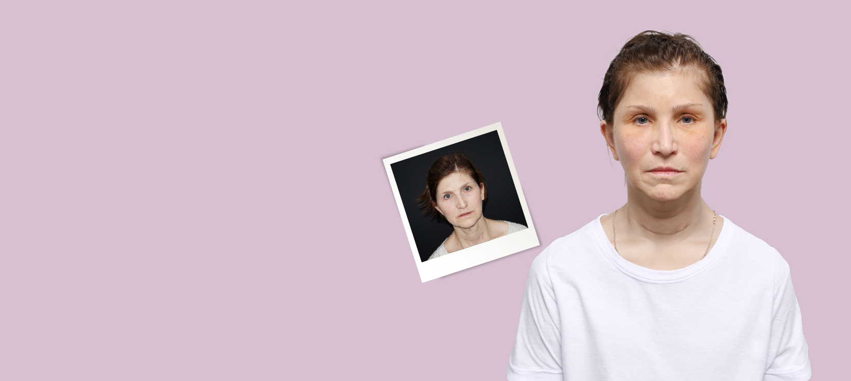 Facelift surgery