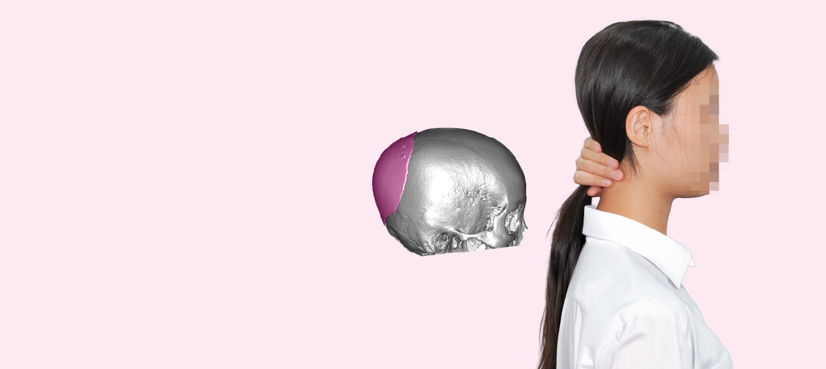 Occipital augmentation