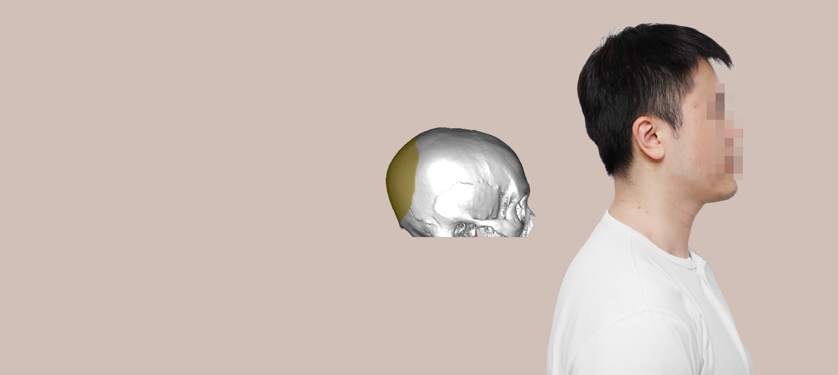 Occipital augmentation
