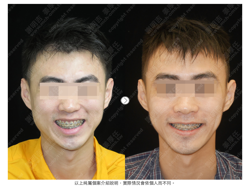 HPW 术前术后对比 1