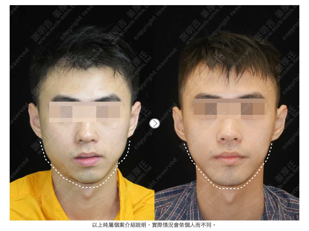 HPW 术前术后对比 2