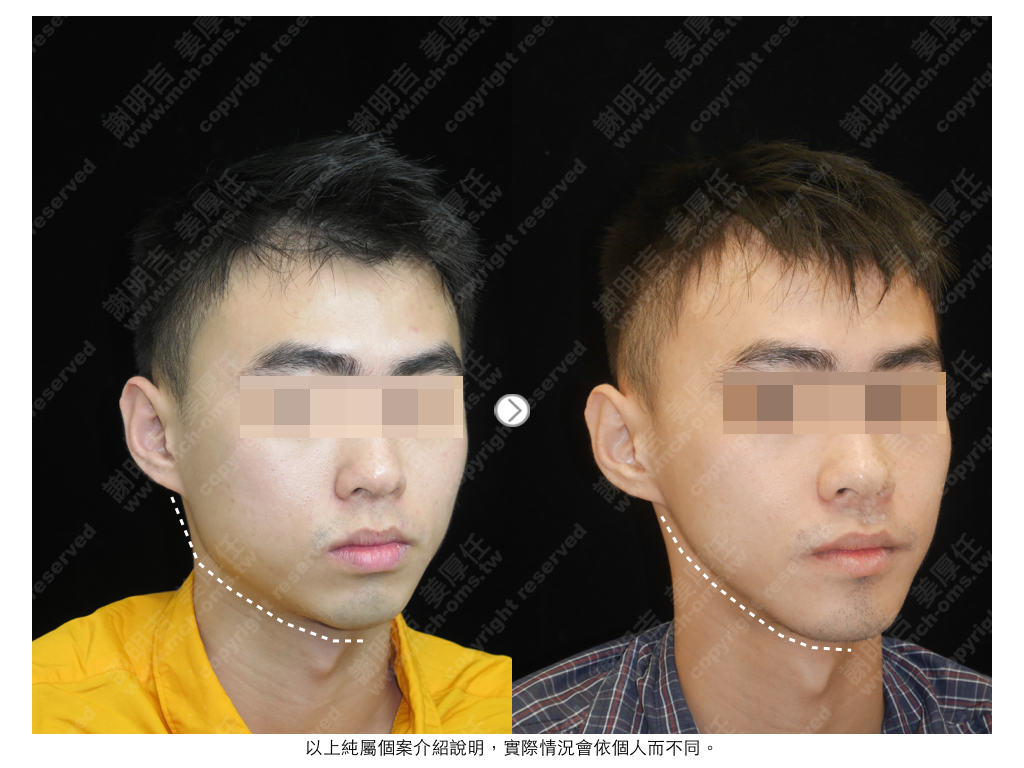 HPW 术前术后对比 3