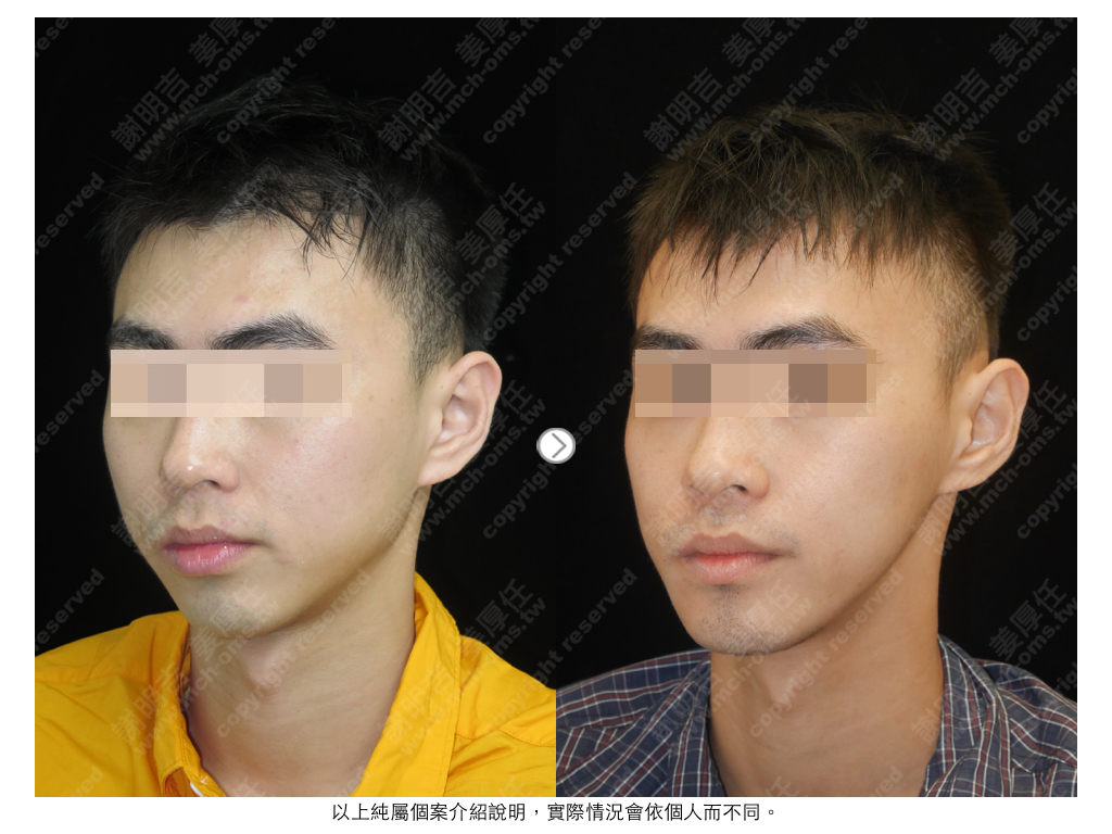 HPW 术前术后对比 4