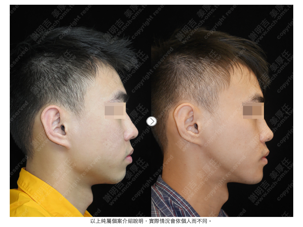 HPW 术前术后对比 5