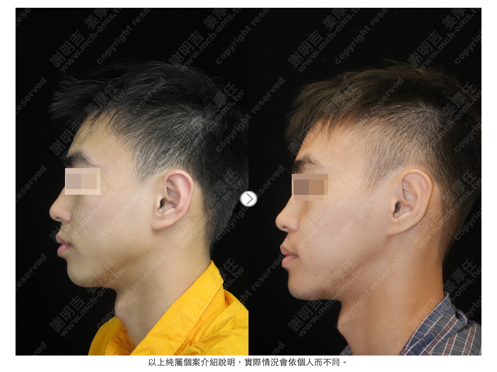 HPW 术前术后对比 6