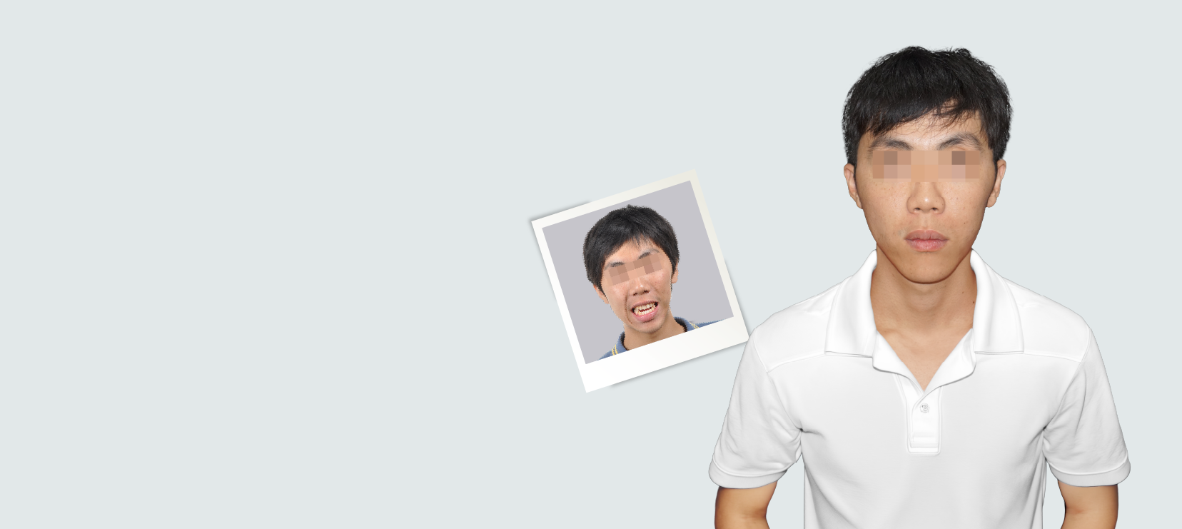 Severe facial asymmetry