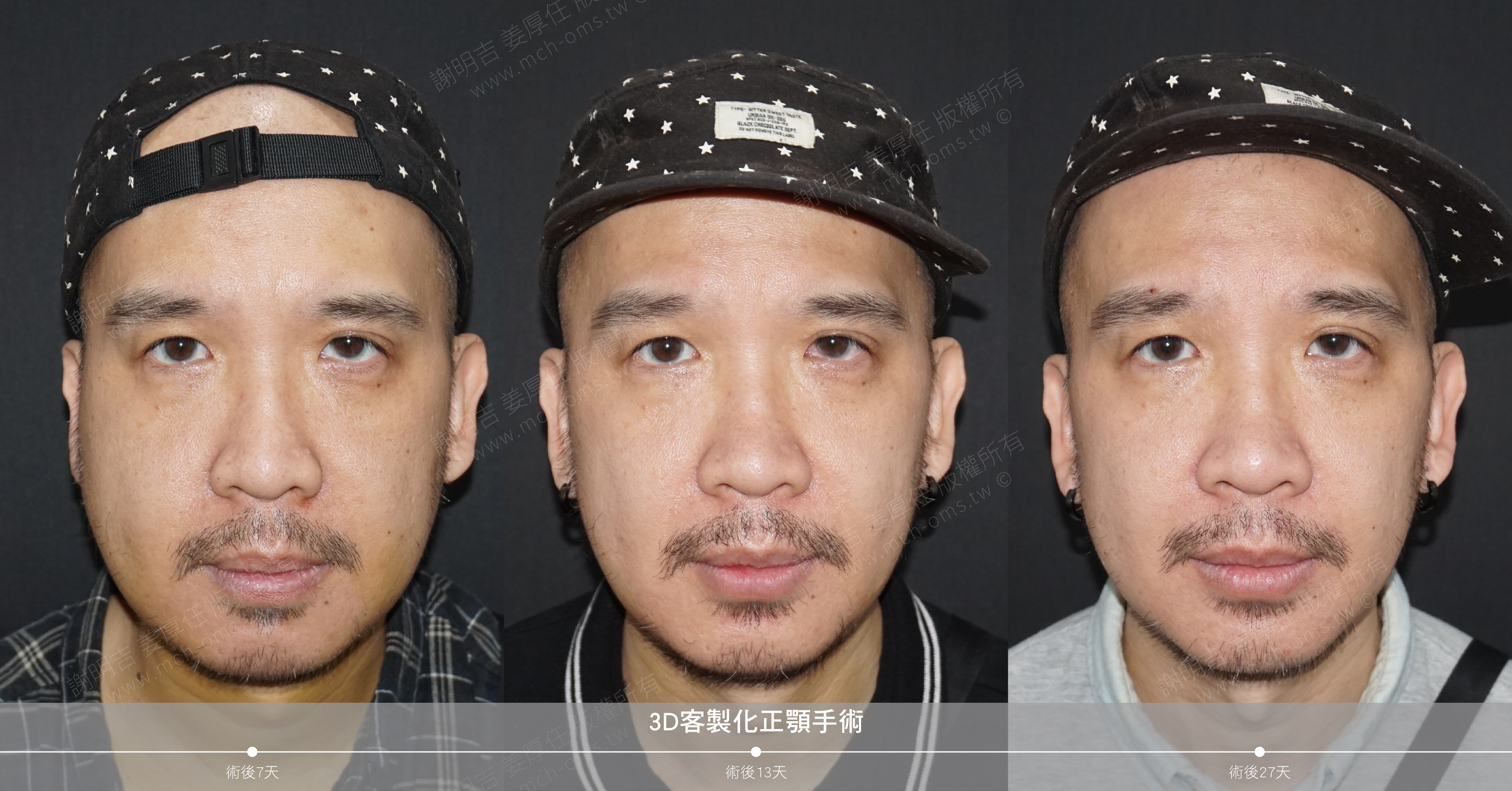 正顎手術 睡眠呼吸中止