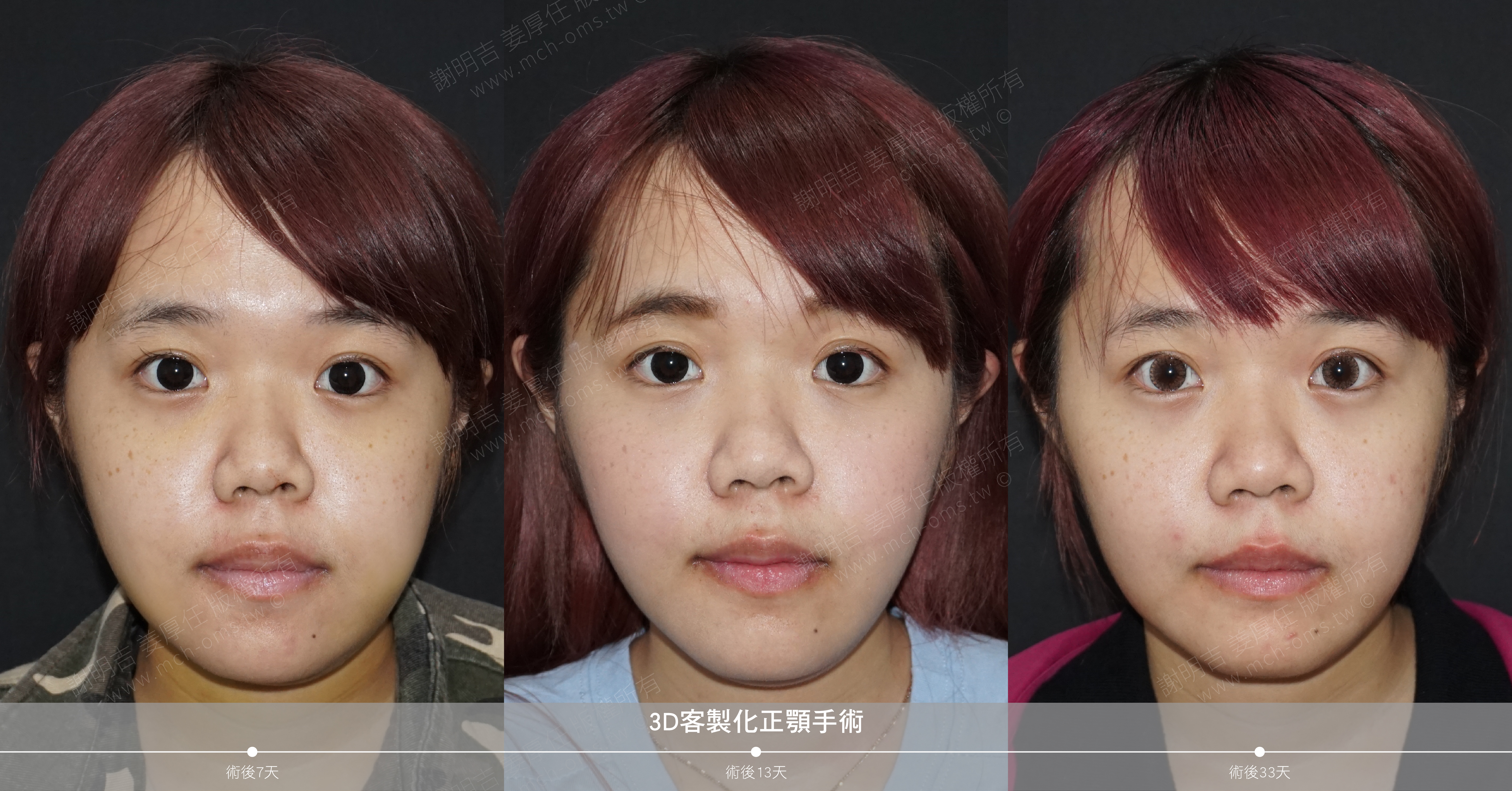 正顎手術 恢復期 手術前後比較 手術照片 手術案例