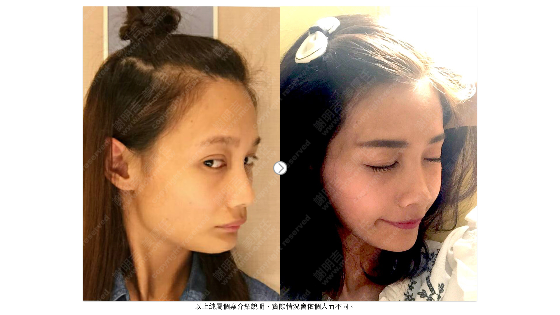 正顎手術 後縮 沒下巴 削骨 國字臉