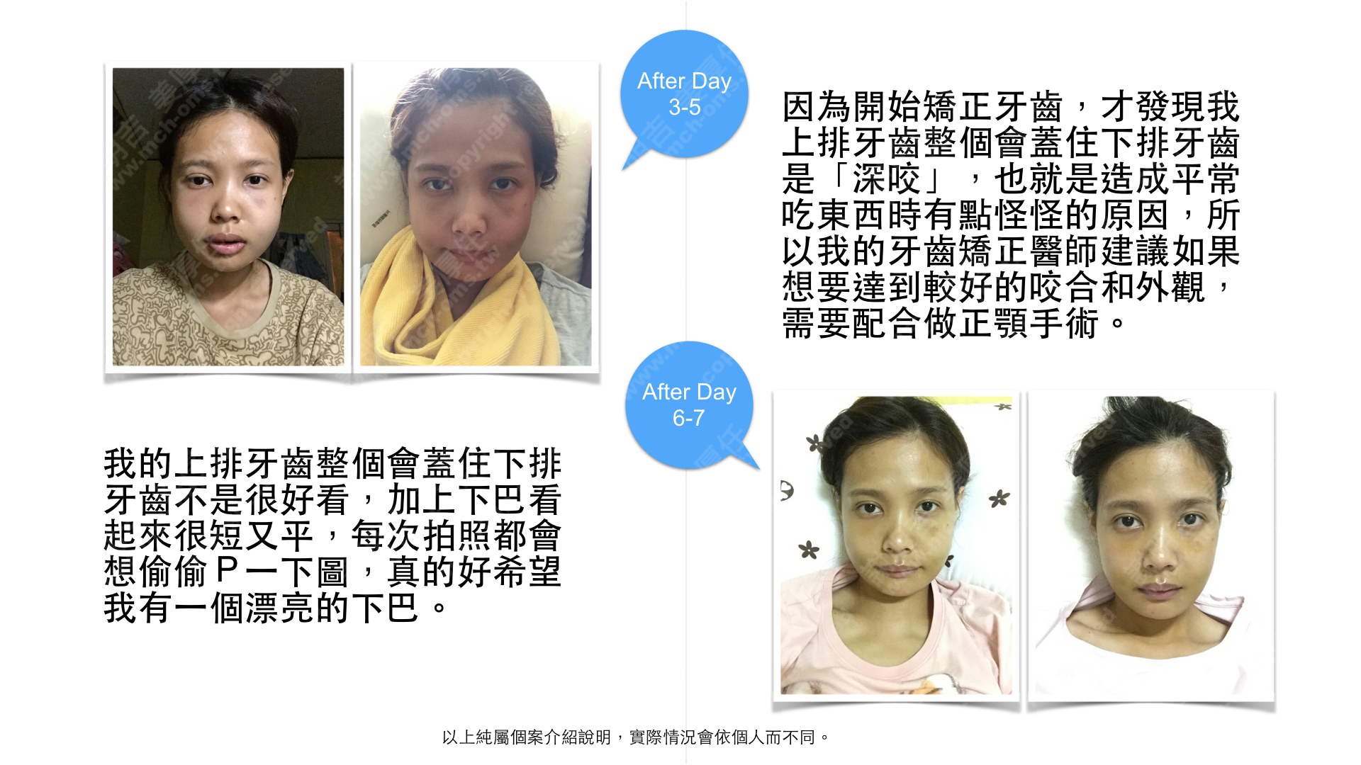 正顎手術 後縮 沒下巴 削骨 國字臉