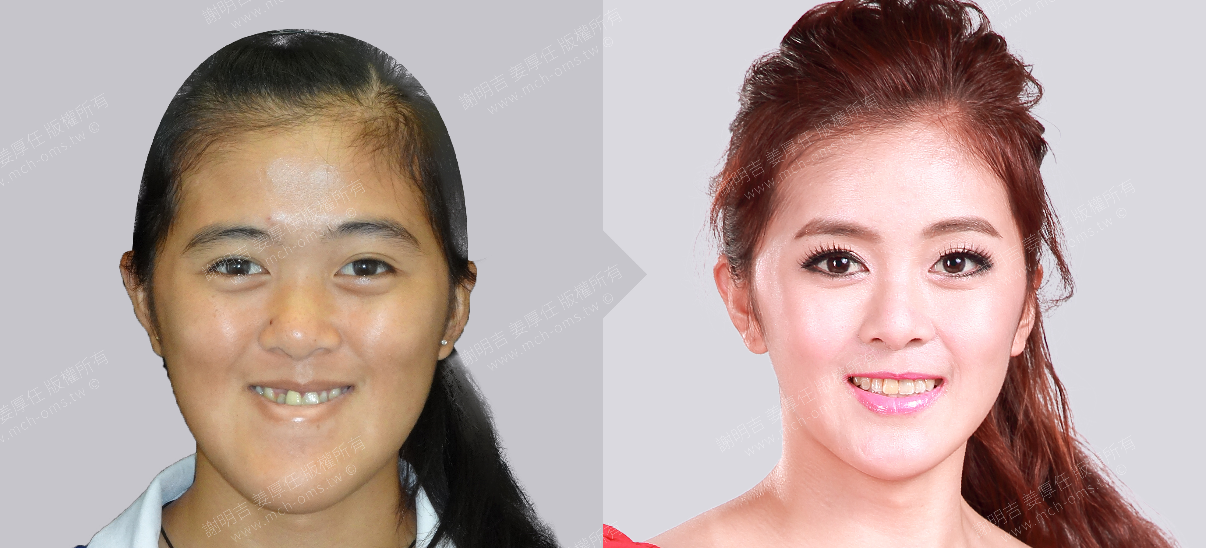 焦點案例26 before and after comparison 2