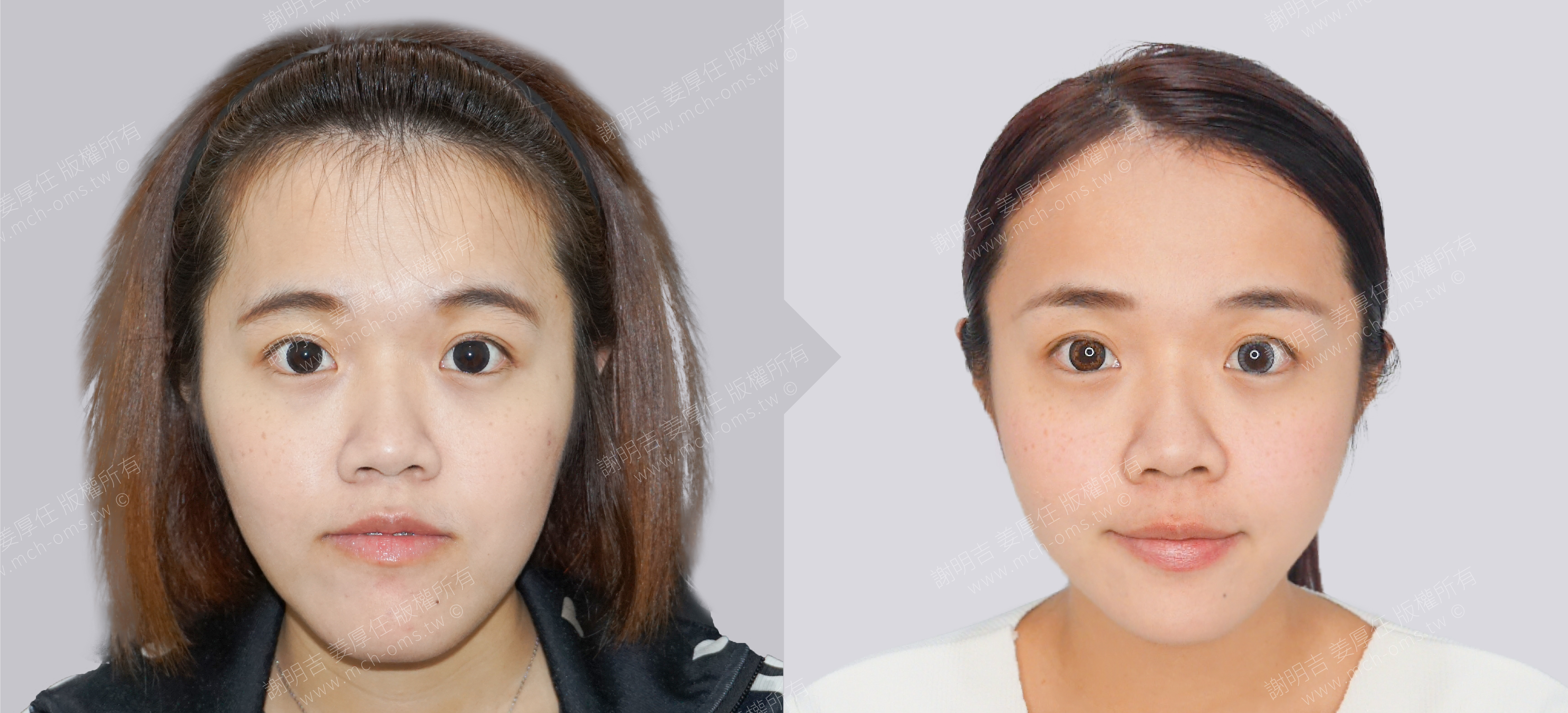 正顎手術 恢復期 手術前後比較 手術照片 手術案例