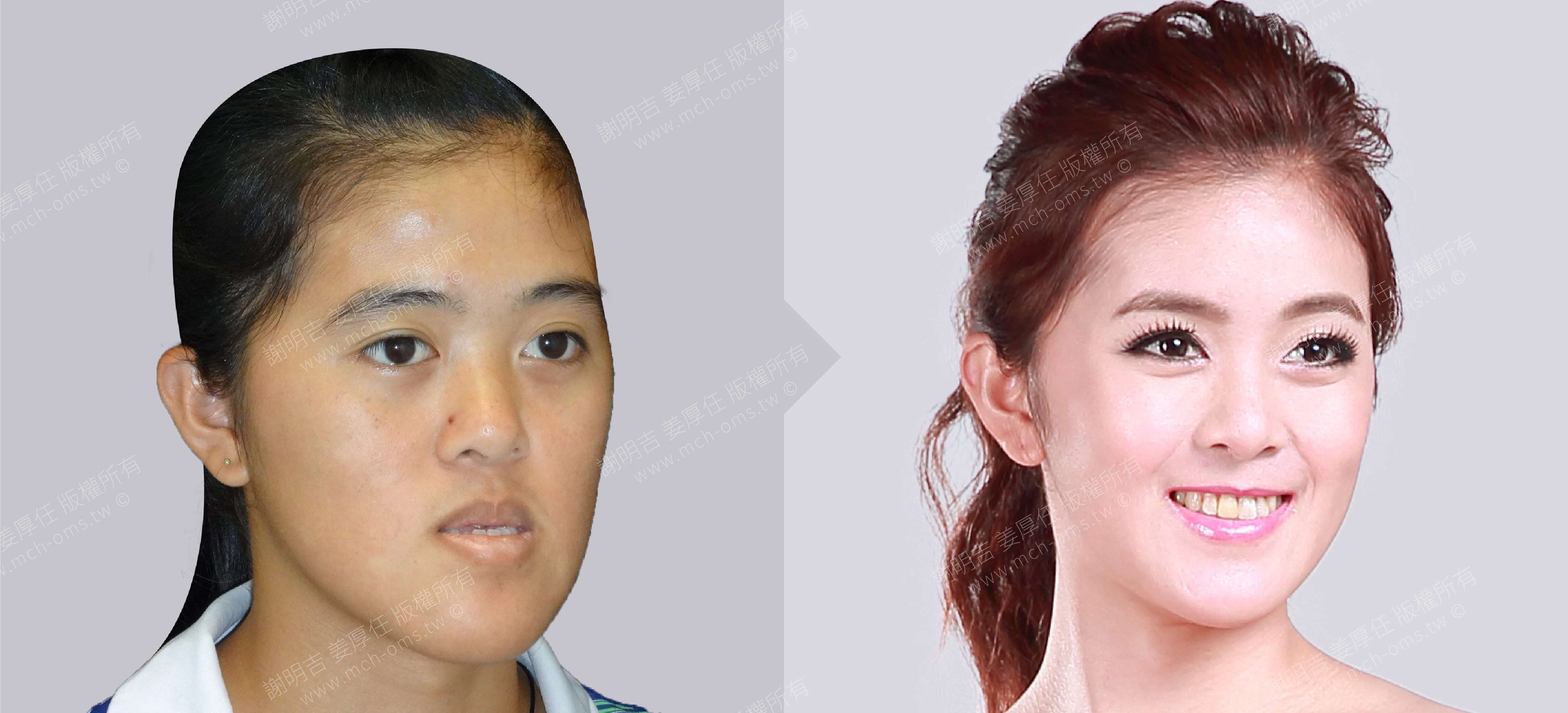 焦點案例26 before and after comparison 3