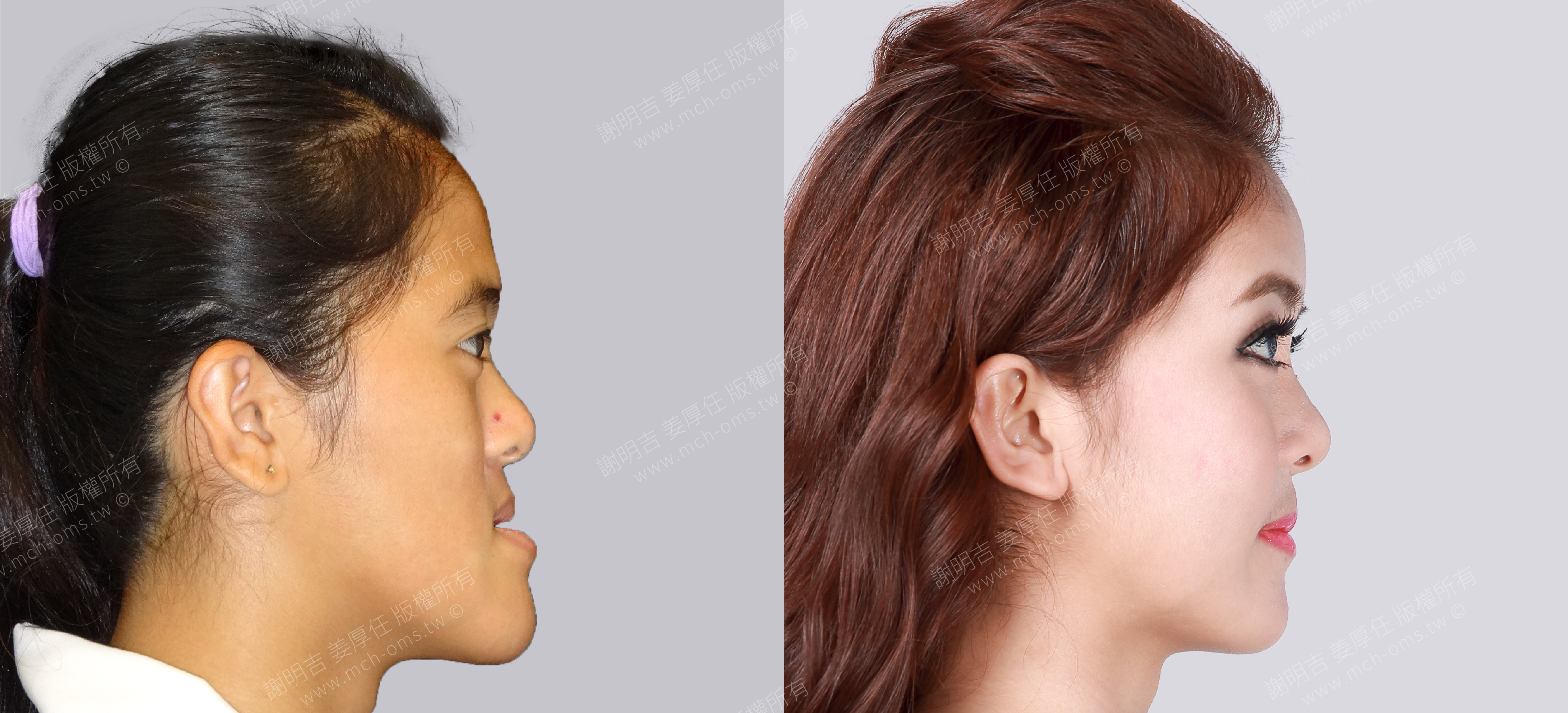 焦點案例26 before and after comparison 4