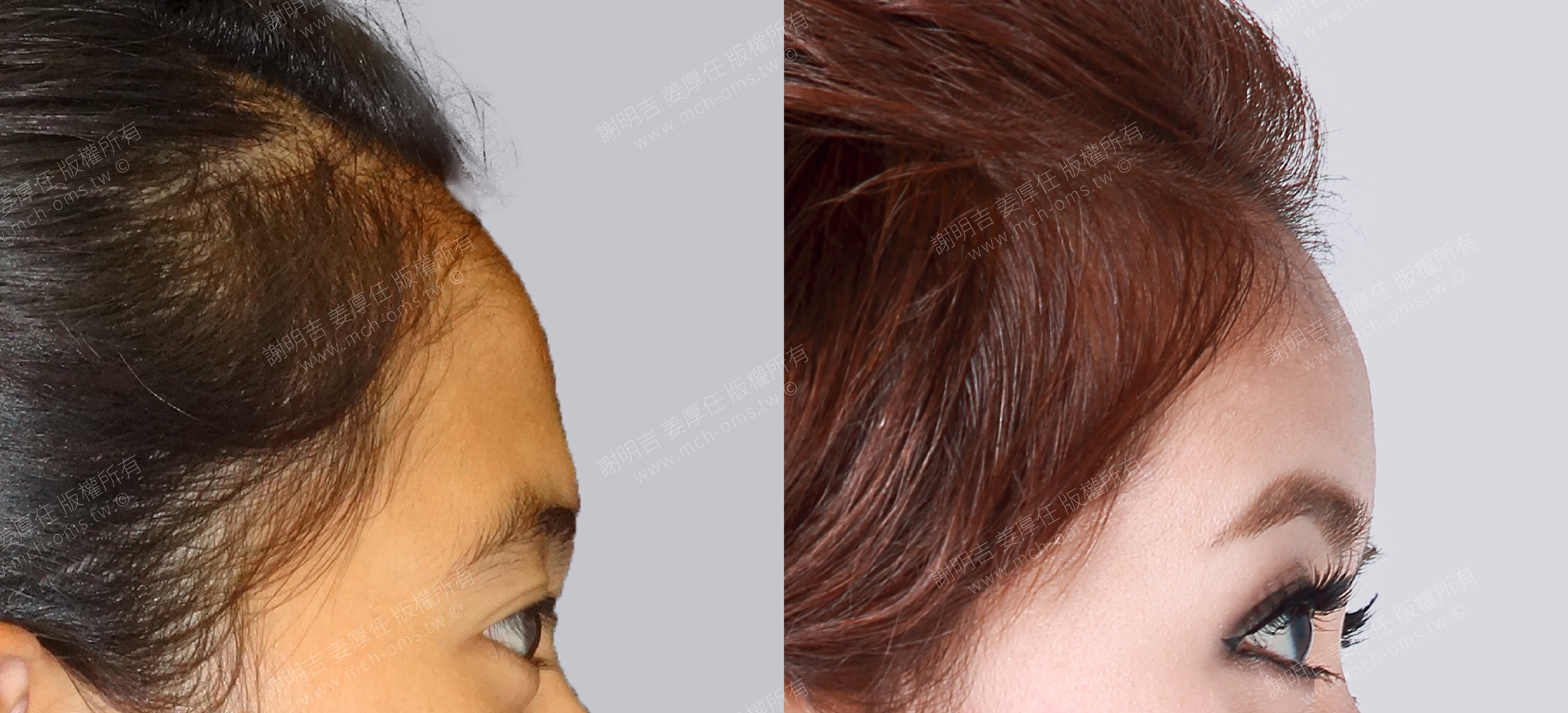 焦點案例26 before and after comparison 5