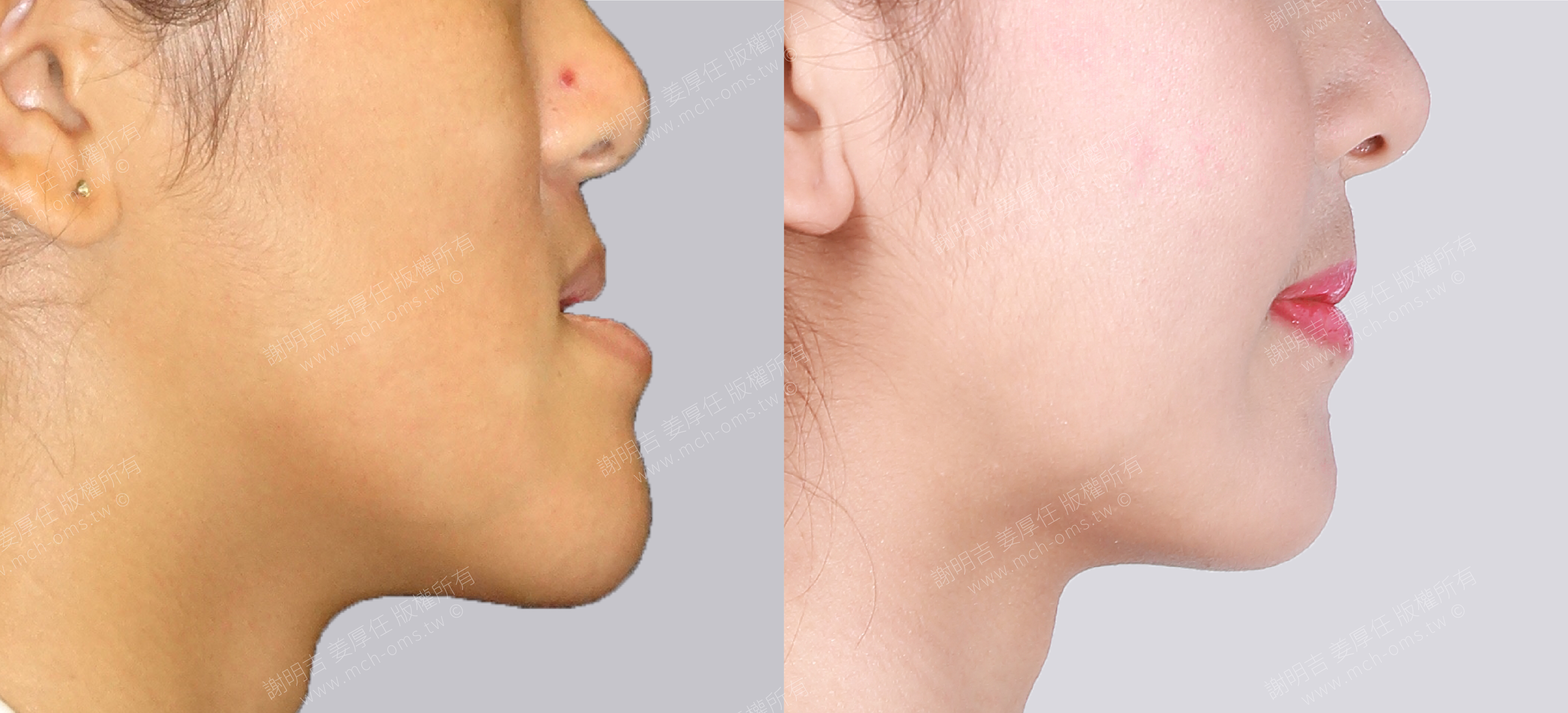焦點案例26 before and after comparison 6