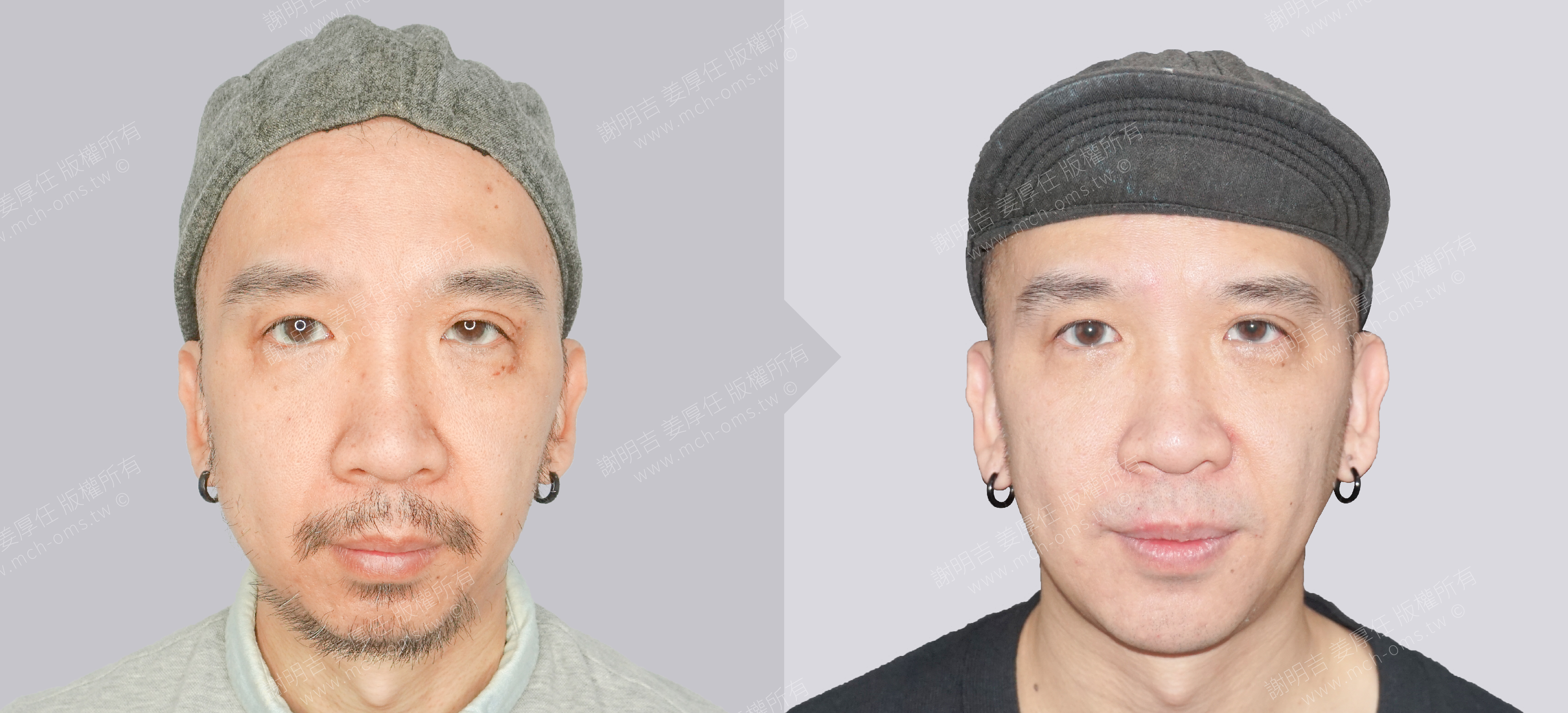 正顎手術 睡眠呼吸中止