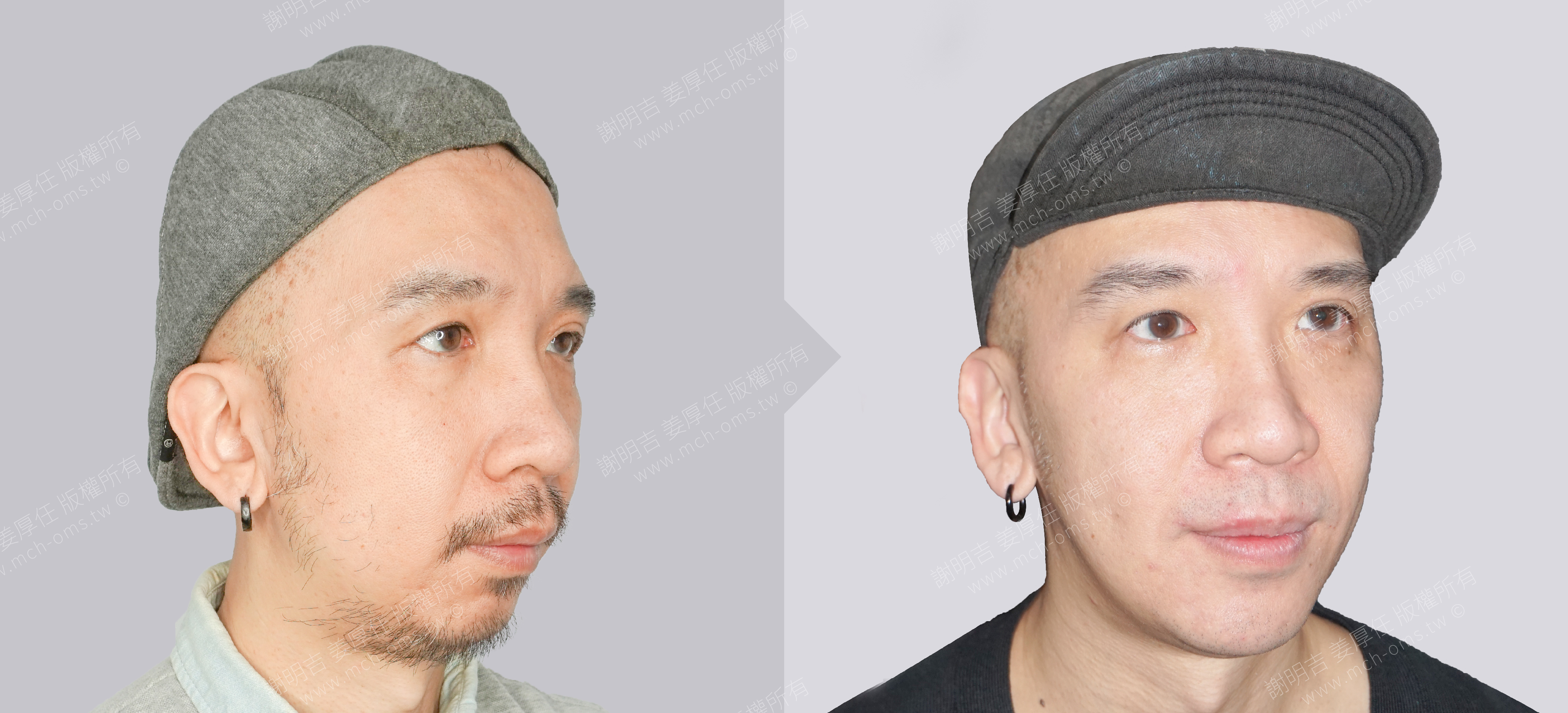正顎手術 睡眠呼吸中止