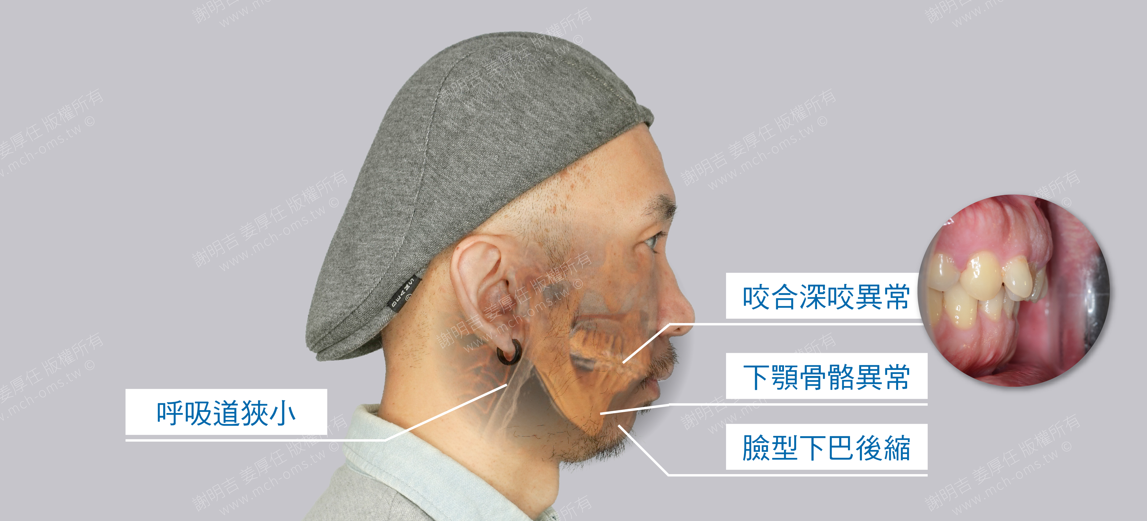 正顎手術 睡眠呼吸中止