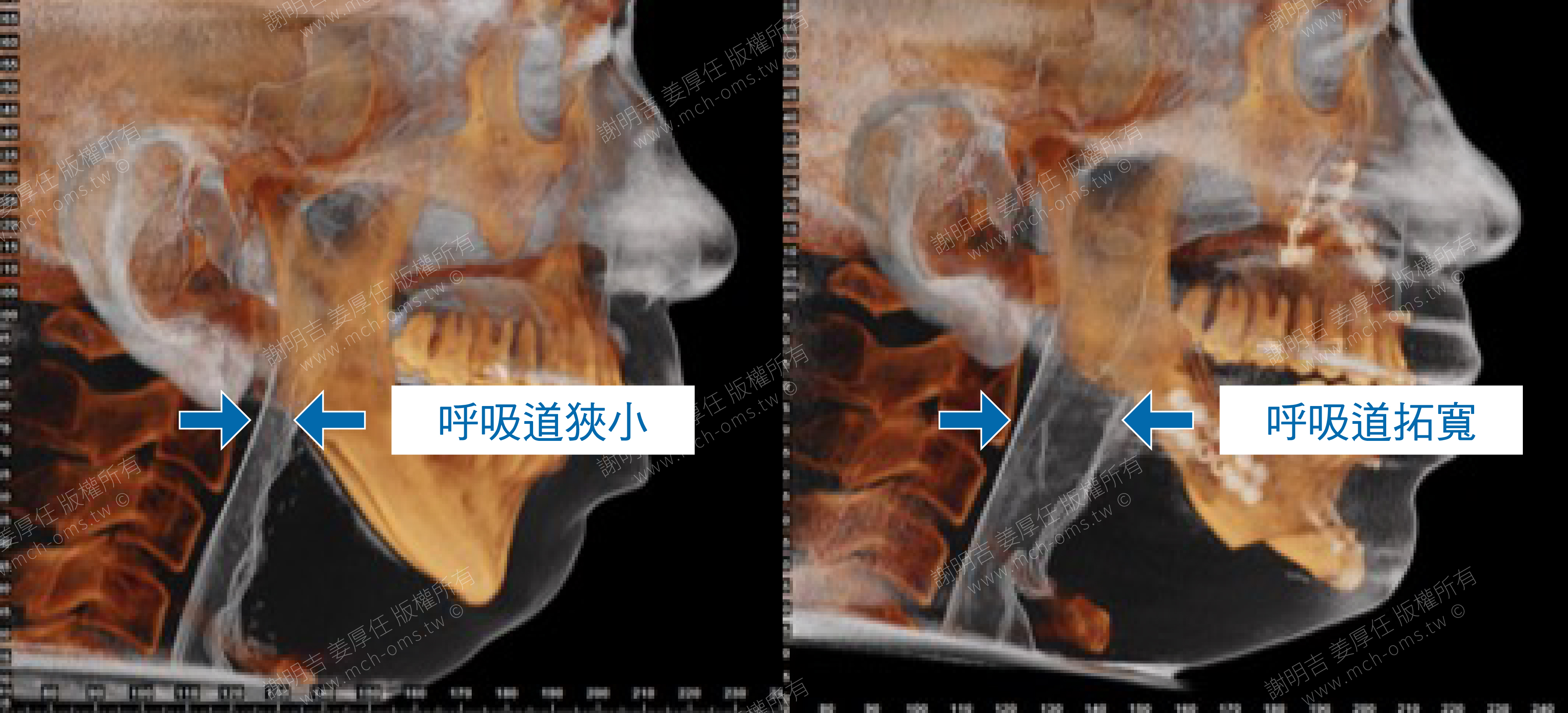 正顎手術 睡眠呼吸中止