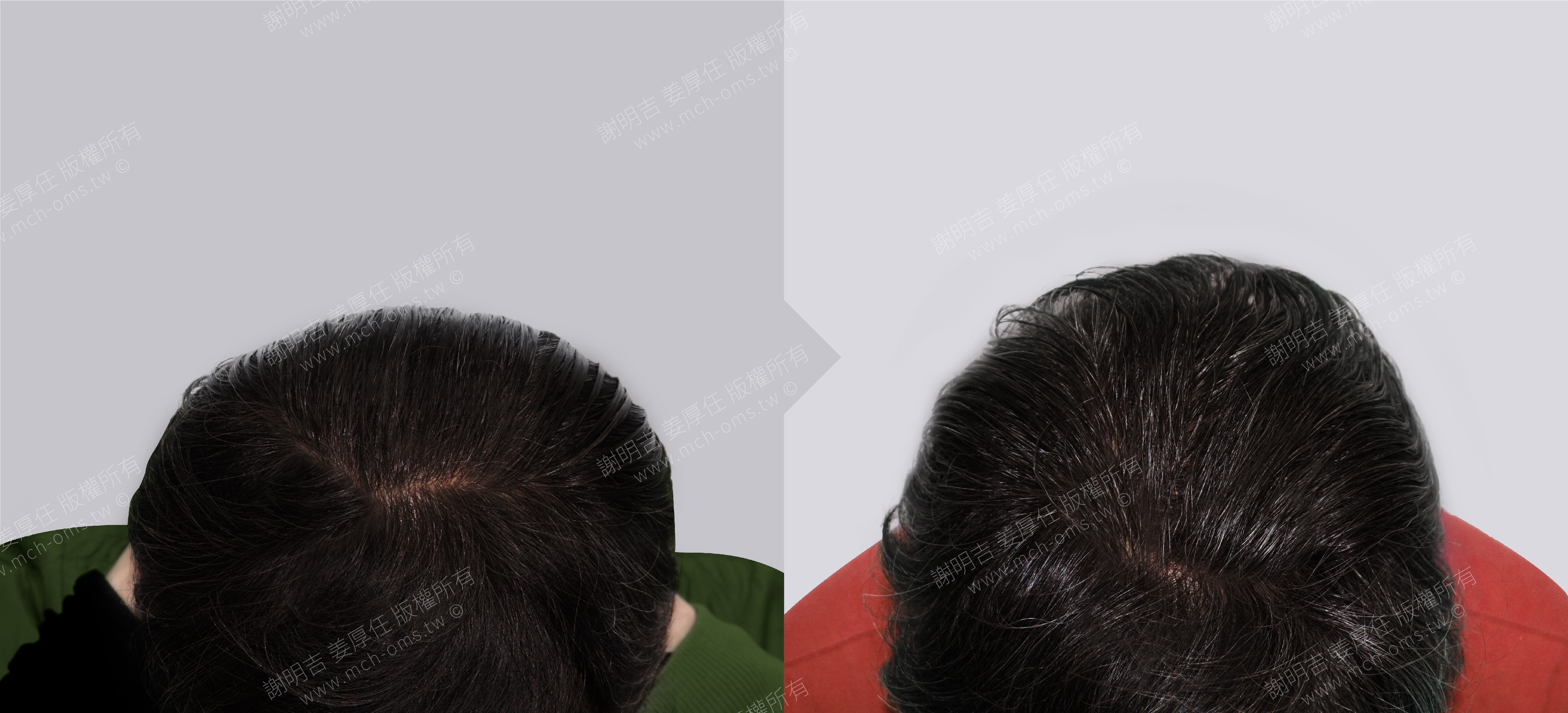 後腦勺 扁頭 頭型 手術