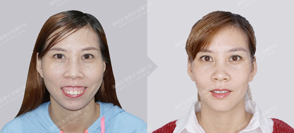 正顎手術 恢復期 手術前後比較 手術照片 手術案例 削骨手術