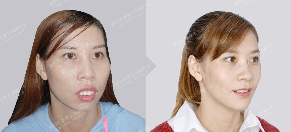 正顎手術 恢復期 手術前後比較 手術照片 手術案例 削骨手術